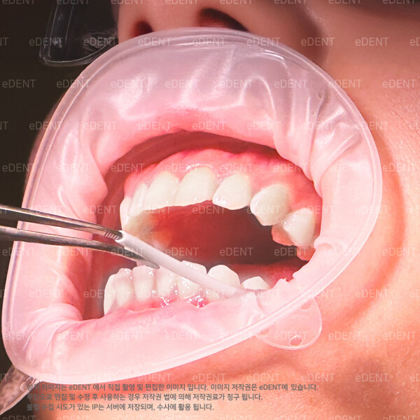 (주)이덴트 치과재료·치과의약품 전문,COMFITRACT Cheek Retractor